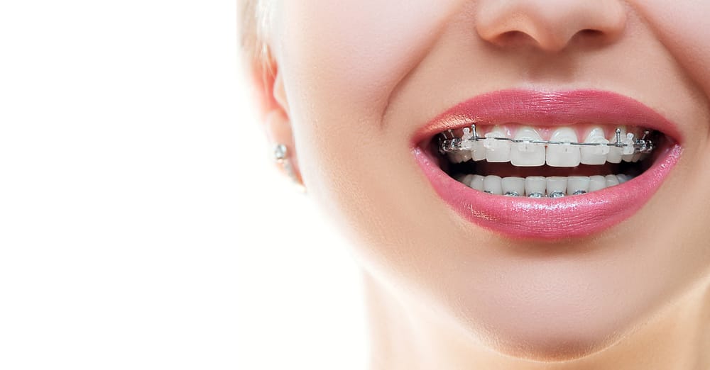 What Are Dental Braces?